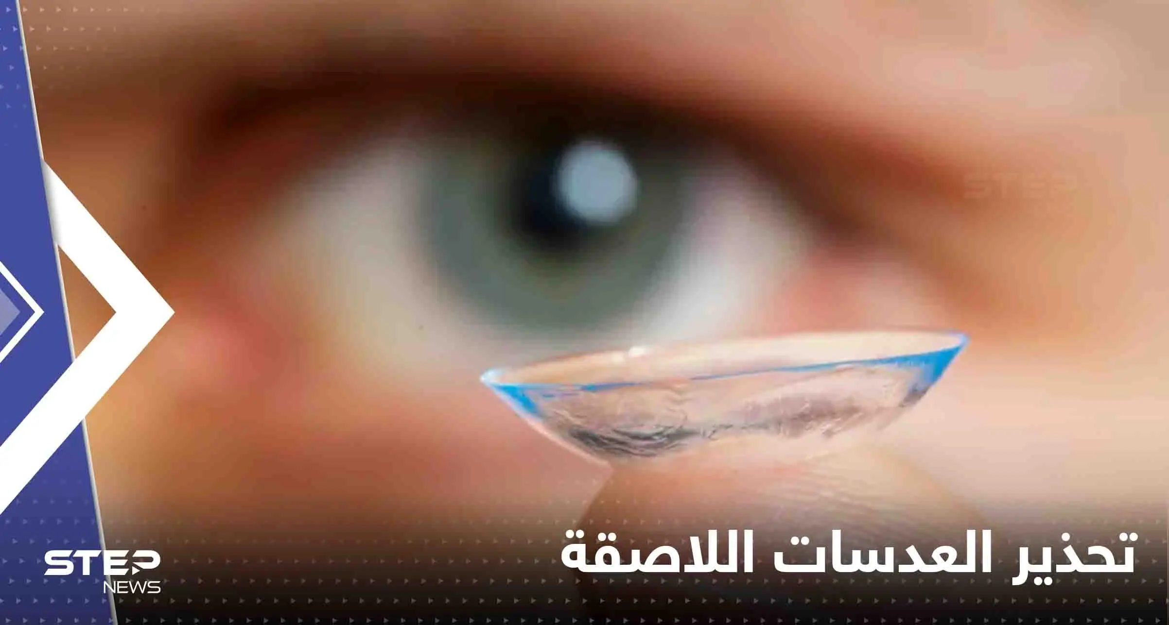 شاب يفقد بصره جزئياً بسبب العدسات اللاصقة.. وخبراء يحذرون: العدسات اللاصقة