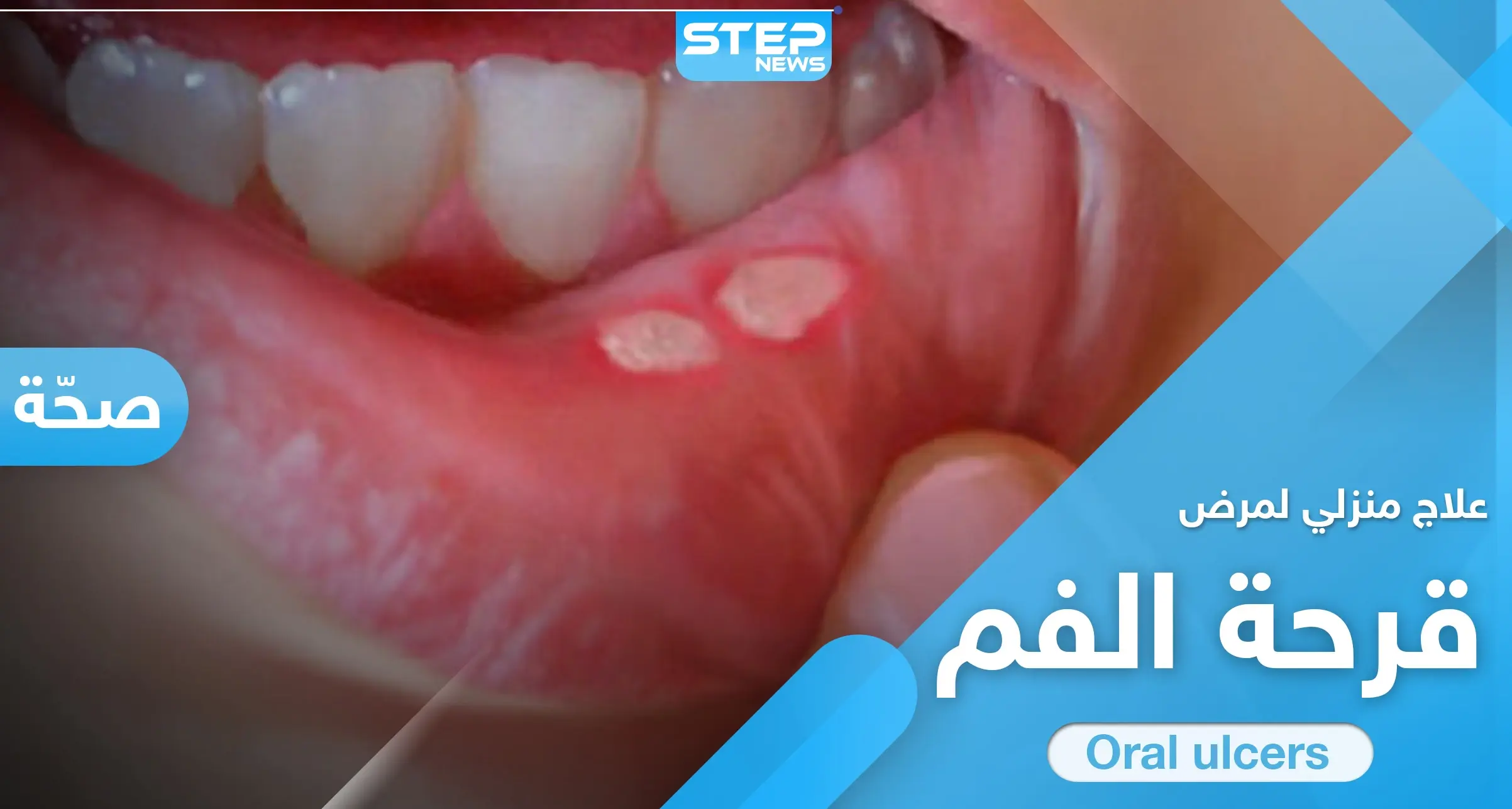 علاج قرحة الفم في المنزل.. إليك الطريقة و7 نصائح هامة: قرحة الفم