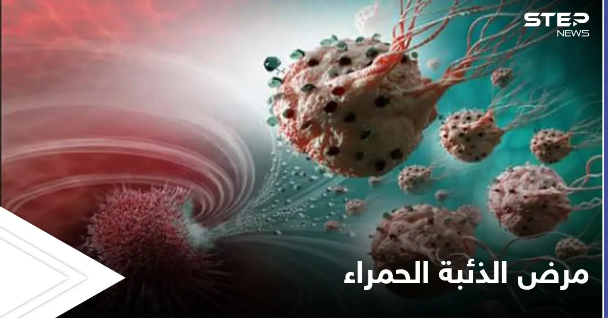 في الشهر العالمي لمكافحته.. تعرف على مرض الذئبة الحمراء وخطورته وأنواعه الشائعة: الجلد