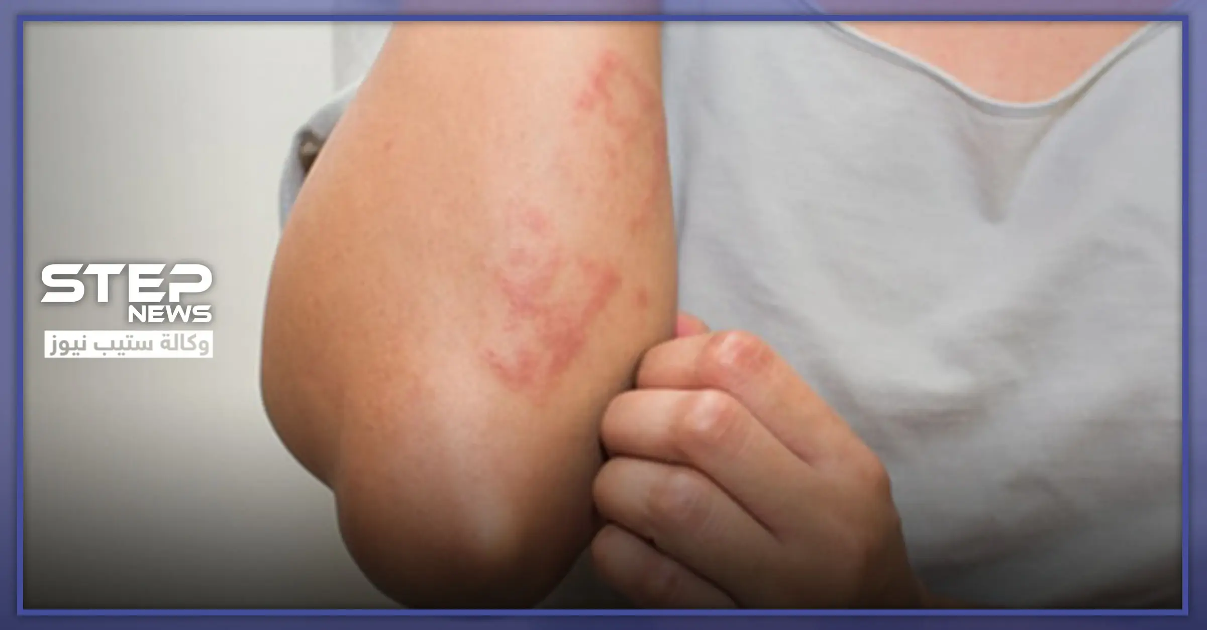 لوراتادين الجيل الـ 2 من مضادات مستقبلات الهيستامين.. الاستطبابات والجرعة الدوائية: نزلات البرد