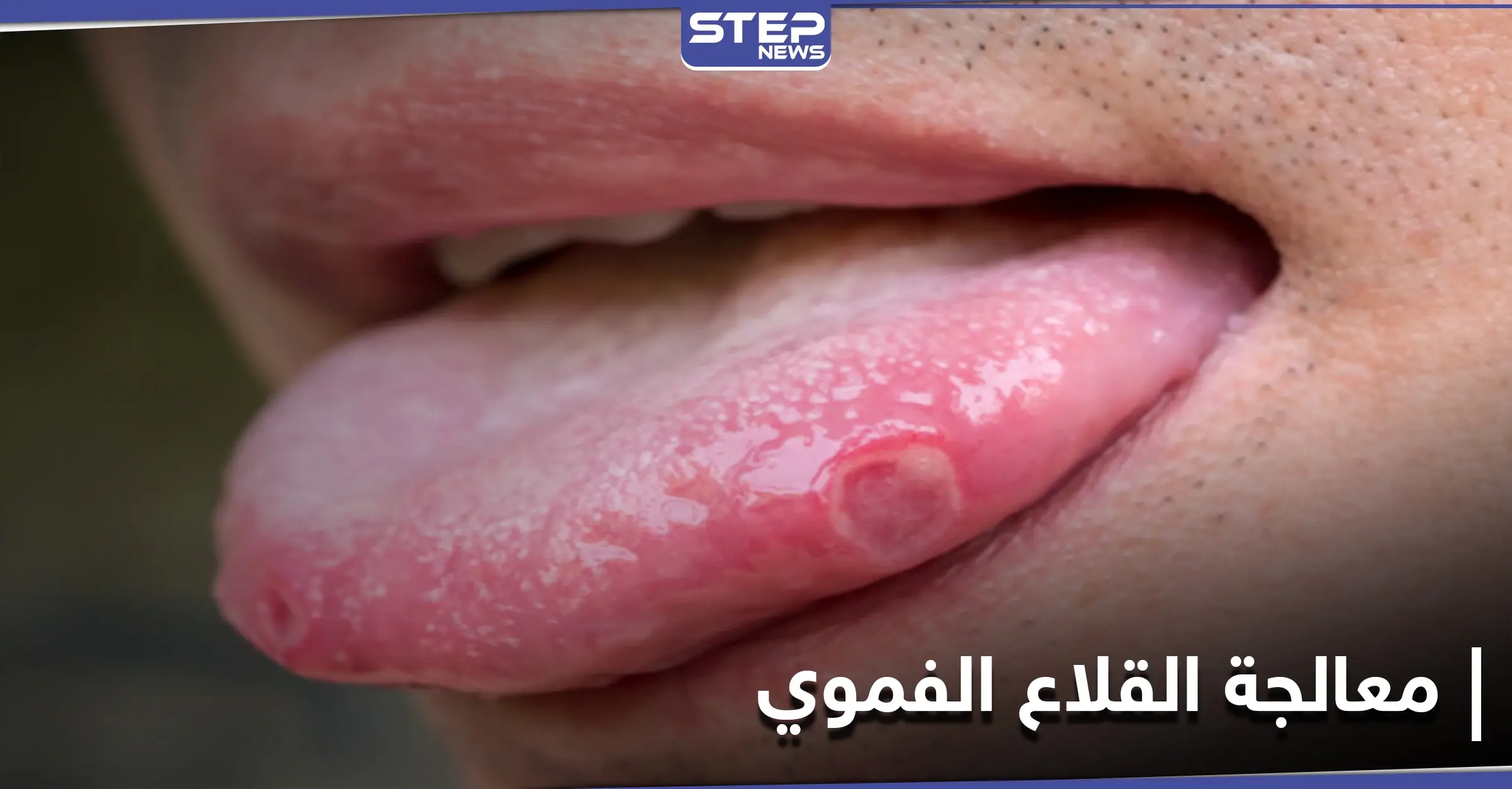 علاجات منزلية مذهلة للتخلص من القلاع الفموي بشكل طبيعي.. إليك 4 طرق: مرضى السكري