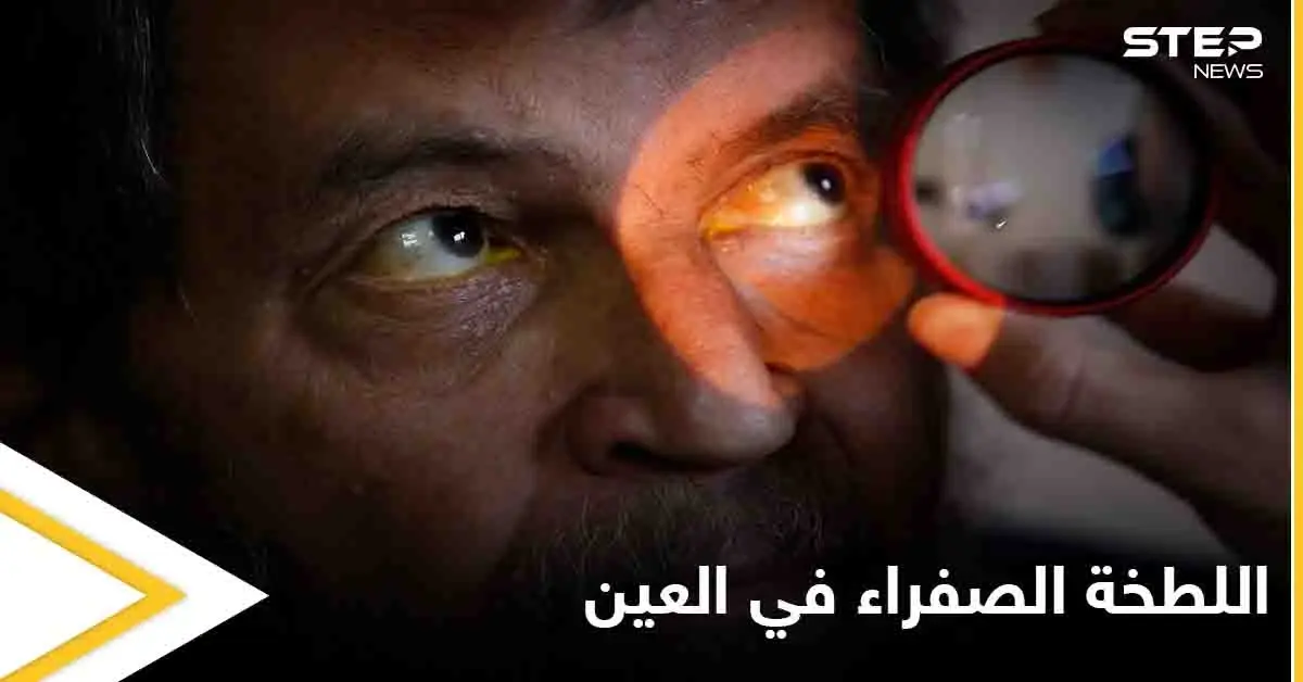 تعرف على أسباب ظهور اللطخة الصفراء في العين وعلاجاتها: ملتحمة العين