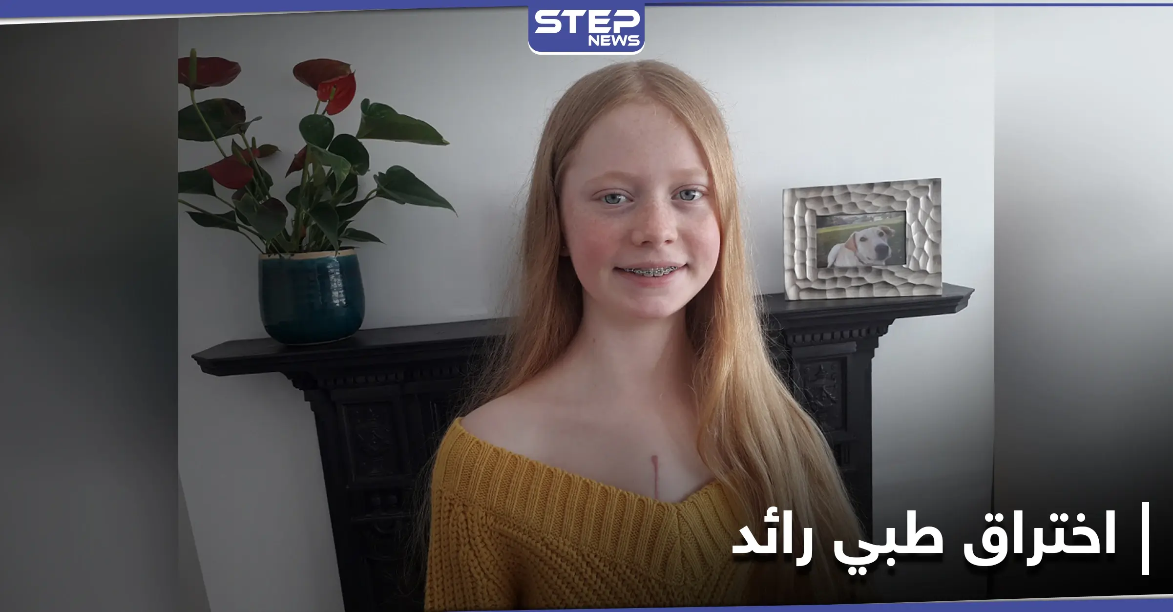 بفضل اختراق طبي كبير في عمليات زراعة القلب.... أُعيدت آنا إلى الحياة من جديد: التبرع بالأعضاء