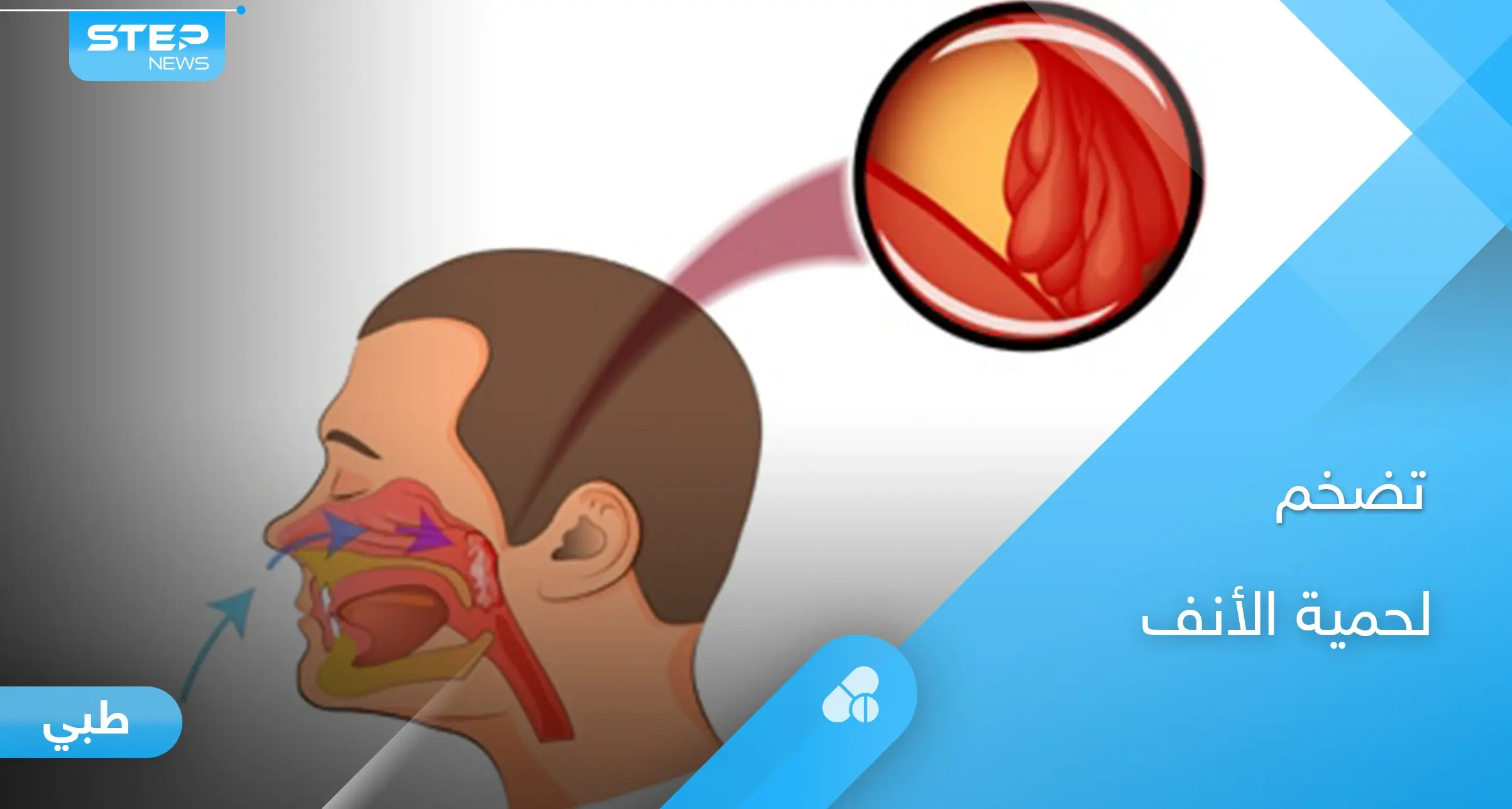 أسباب تضخم لحمية الأنف وطرق اكتشاف اللحمية مبكرًا عند الأطفال: جفاف الفم