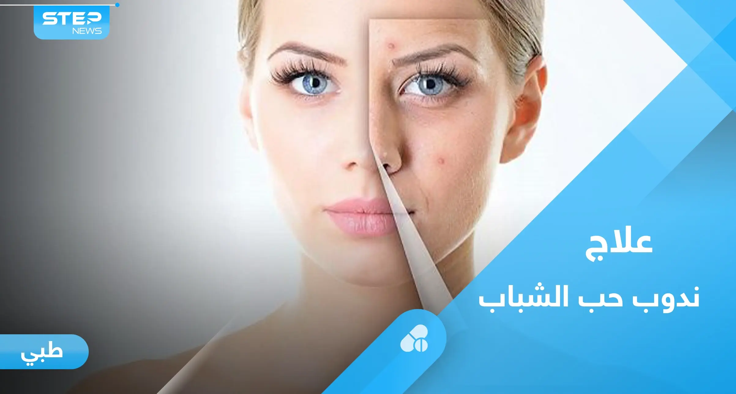 متى يترك حب الشباب ندباً وما الطريقة الأفضل لعلاجه.. إليك رأي الخبراء: علاج حب الشباب