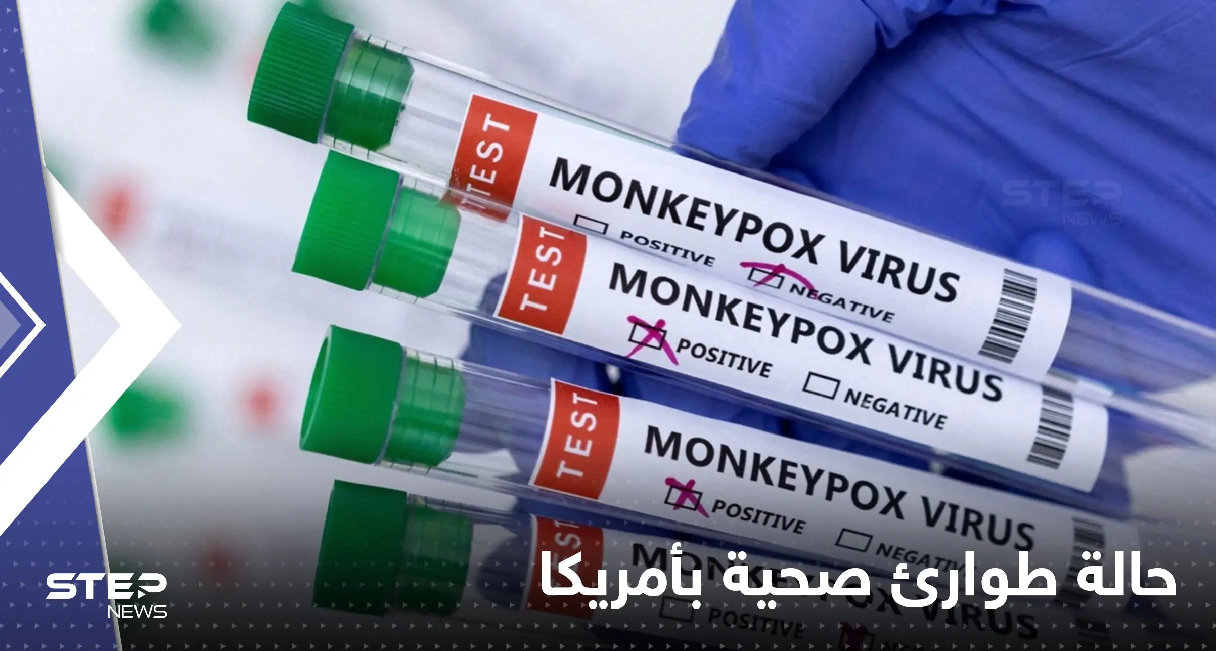 جدري القردة يجبر الإدارة الأمريكية على إعلان "حالة طوارئ صحية": جدري القردة