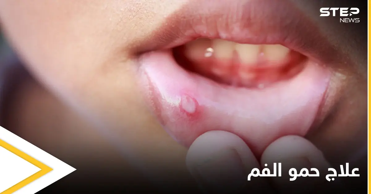 ما هي أسباب ظهور حمو الفم ومتى يكون خطيراً ويحتاج إلى التدخل الطبي إليك أهم المعلومات: تقرحات فموية