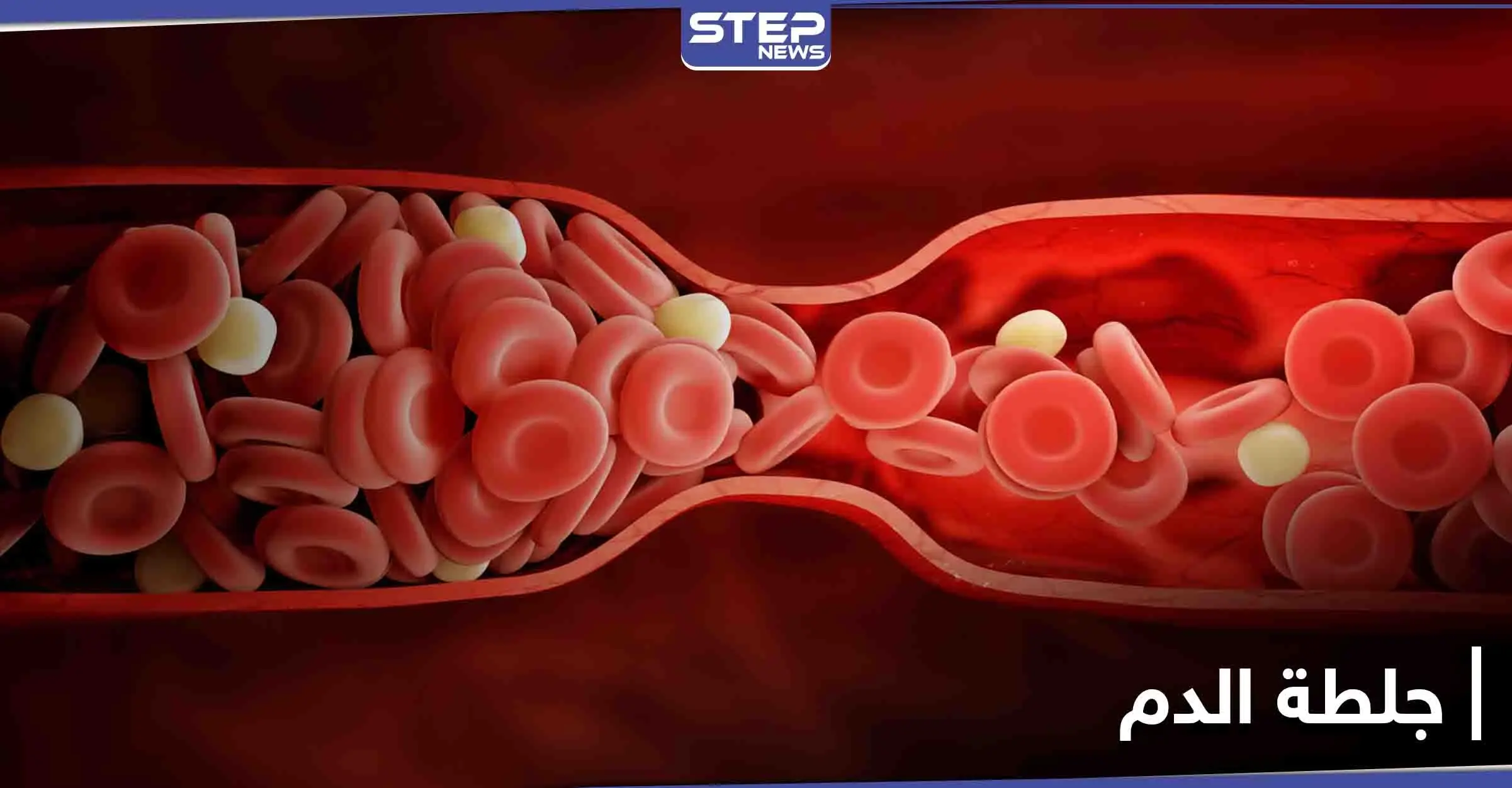 أعراض جلطة الدم وأخطارها وطرق الوقاية منها: جلطة الدم