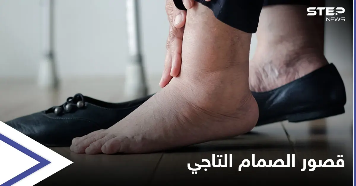 منها تورم القدمين.. تعرف على أعراض قصور الصمام التاجي وأسبابه وطرق العلاج: الصحة