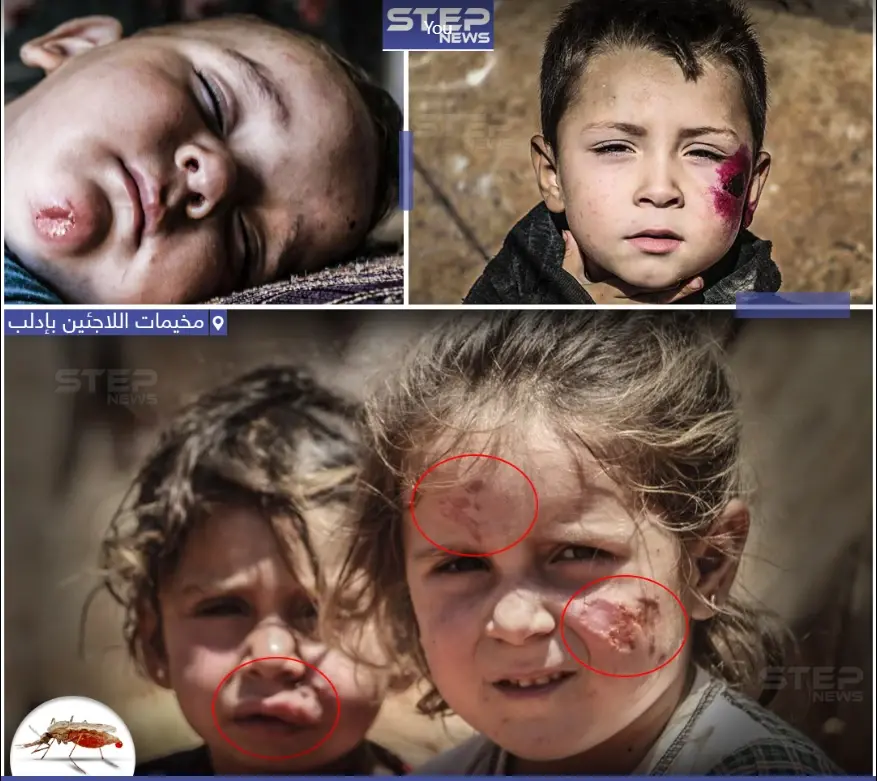 انتشار داء الليشمانيا بين اللاجئيين السوريين في مخيمات النزوح بإدلب: مخيمات