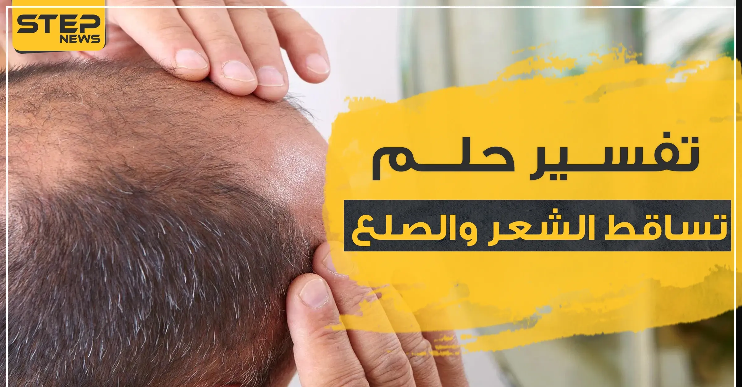 تفسير حلم تساقط الشعر والصلع بحسب ابن سيرين للحامل والمتزوجة والعزباء: الصلع بالمنام