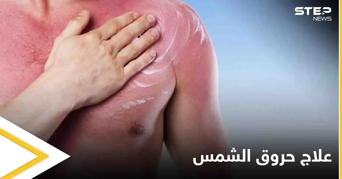 تعرف على أنواع حروق الشمس وأفضل الطرق لعلاجها: حروق الشمس
