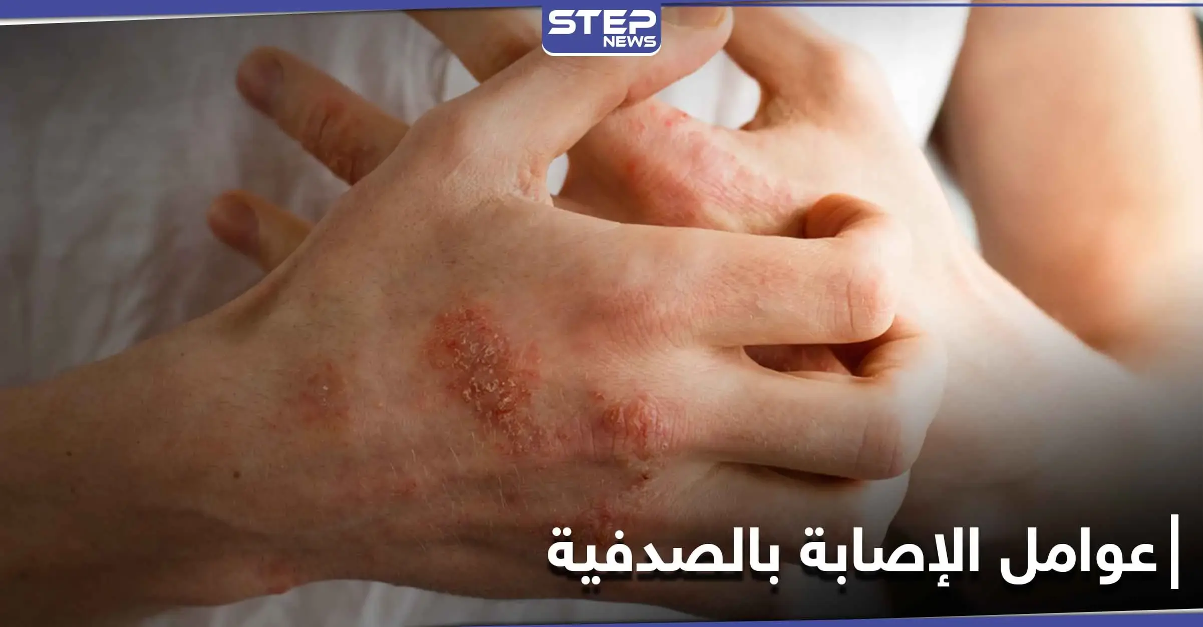 الصدفية تزداد في الفترة الأخيرة.. وهؤلاء الأشخاص هم الأكثر عرضة للإصابة بها: أدوية الضغط