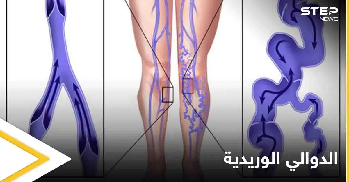 يسبب الكثير من الأعراض المزعجة.. تعرف على مرض الدوالي الوريدية وأسبابه وطرق الوقاية منه: أعراض الدوالي