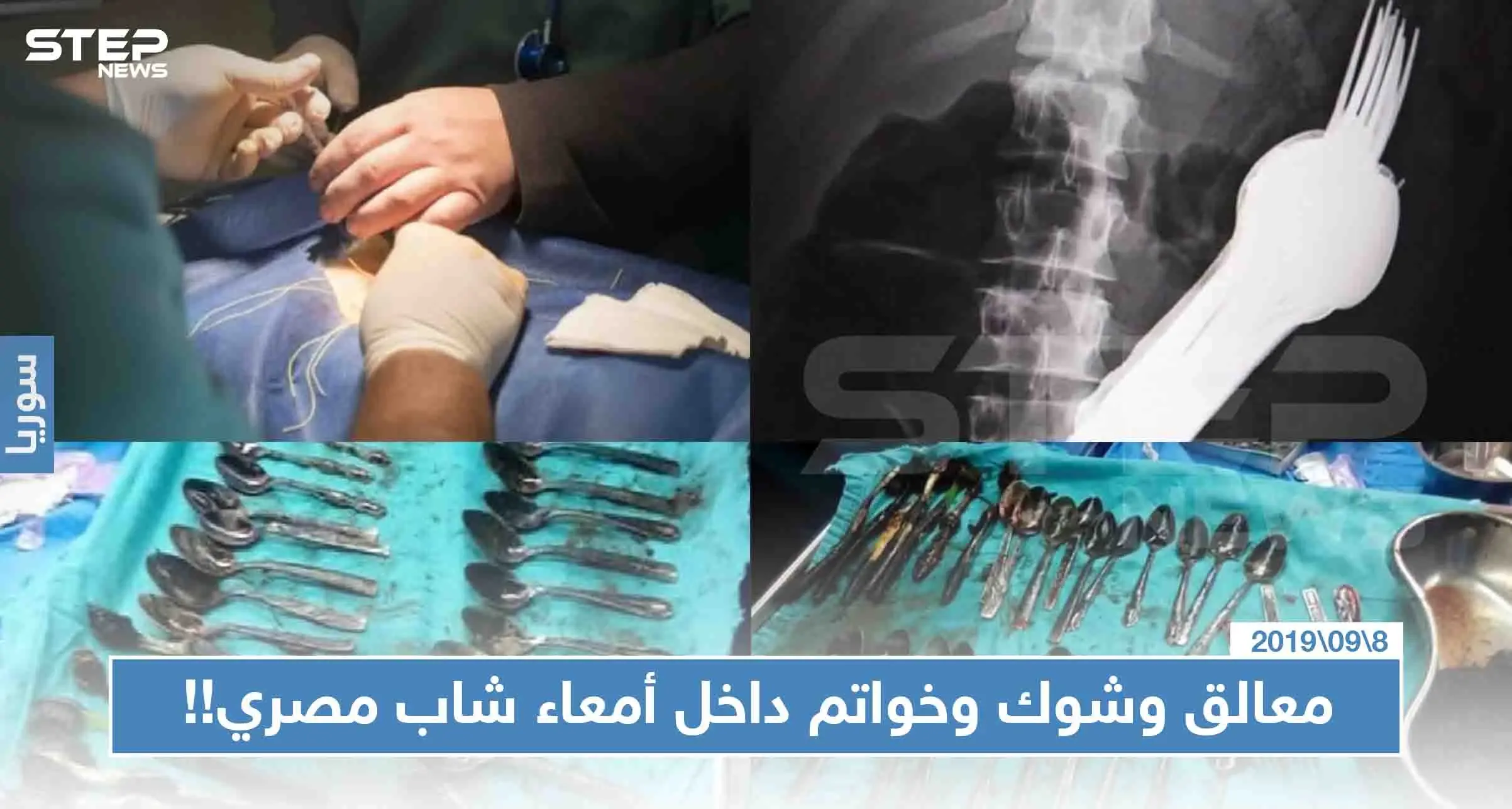 شاب مصري اشتكت والدته من فقدان المعالق والشوك وخاتم ذهبي، فعُثر عليهم داخل معدته!! (صور): مصر