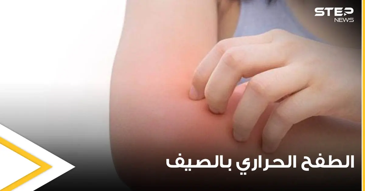 الطفح الحراري في الصيف أعراضه وأسبابه وطرق علاجه: أمراض الصيف