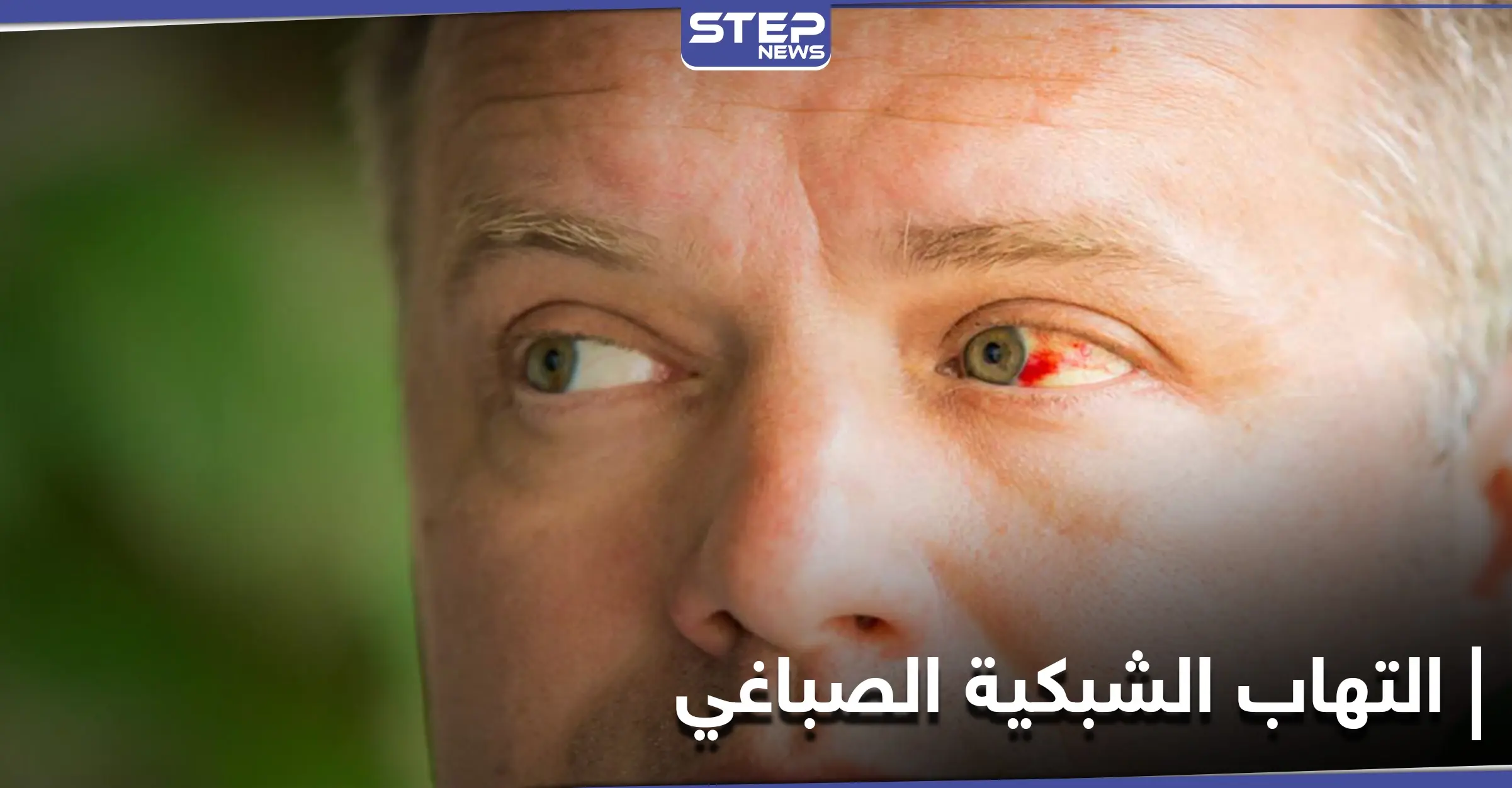 أخطر الإصابات العينية.. التهاب الشبكية الصباغي تعرّف إلى أعراضه وعلاجاته: خلل جينيّ