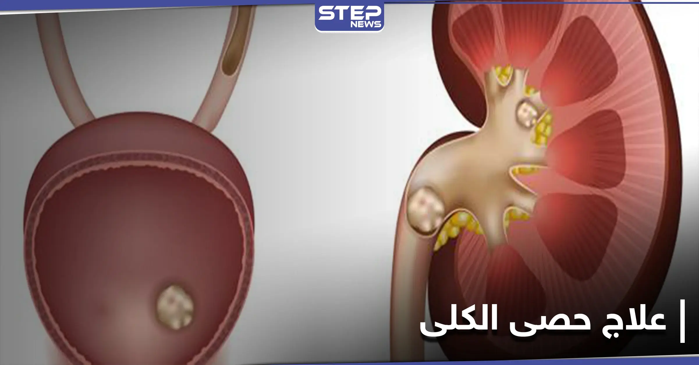 ما لا تعرفه عن حصى الكلى وكيف يمكن معالجتها بالوسائل المنزلية البسيطة: حصى الكلى