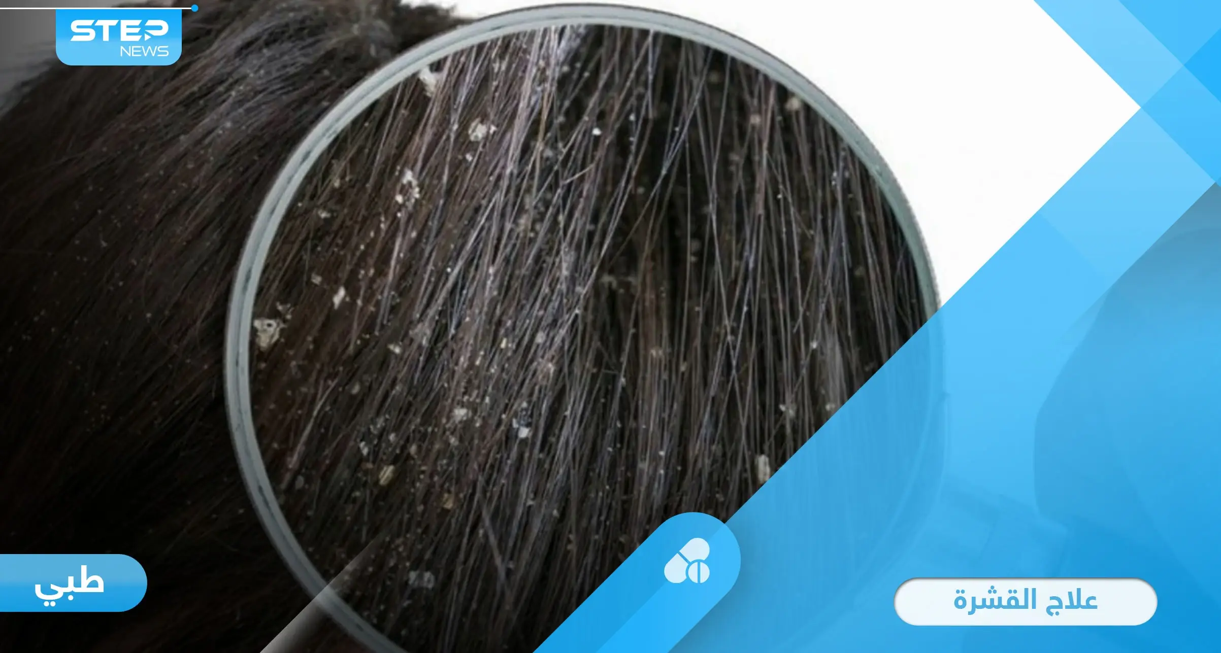 طرق سهلة لعلاج القشرة في المنزل وأسباب ظهورها والوقاية منها: القشرة