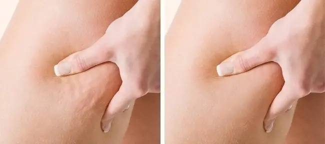عملية إزالة السيلوليت.. مع تعريفه وطرق إزلته بالليزر بتقنية حديثة: ماهو السيليوليت