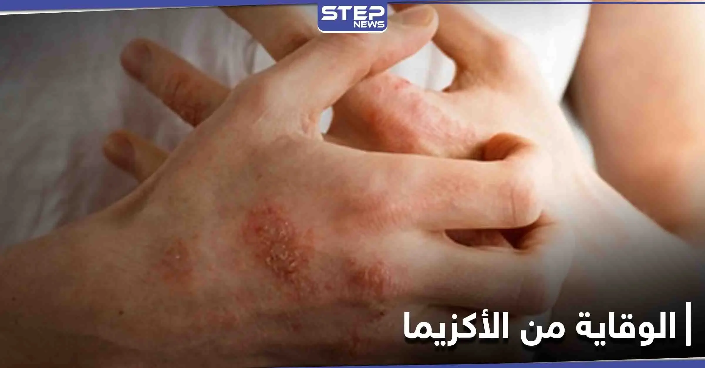 ماهي الأكزيما.. أسباب حدوثها وأهم الطرق للوقاية منها: الأكزيما