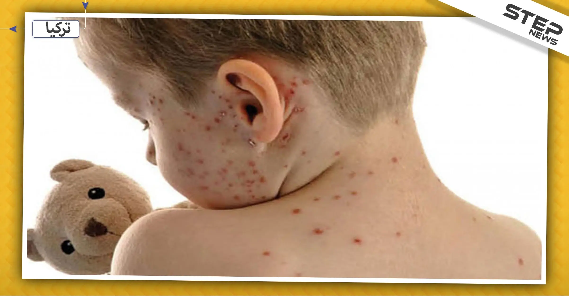 الجرب ينتشر في إسطنبول.. والصحة التركية تحذّر المواطنين: المدن التركية