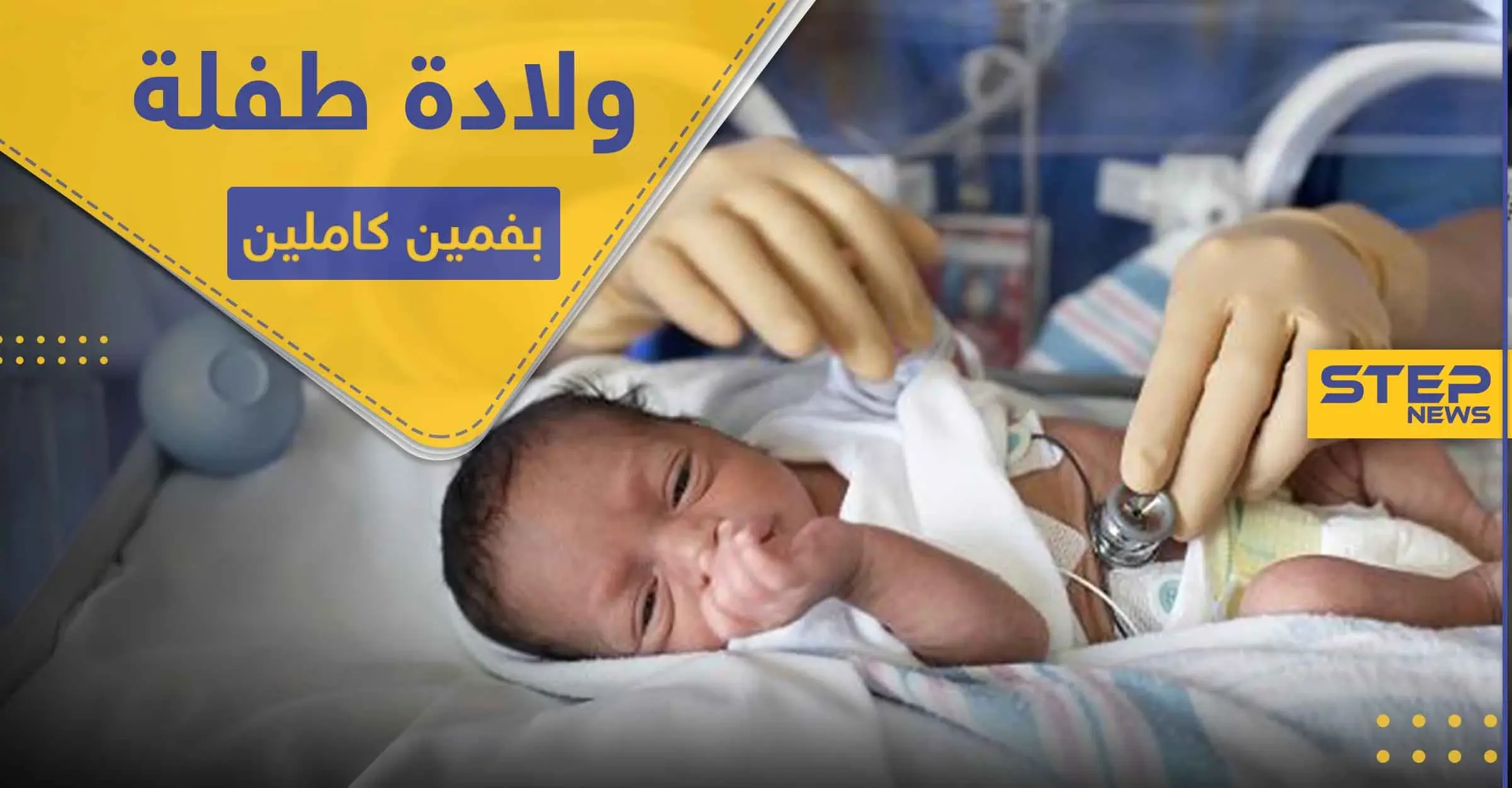 شاهد|| ولادة طفلة بفمين كاملين في حالة طبية نادرة: جنين