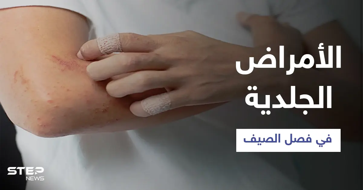 تعرّف على أبرز الأمراض الجلدية الشائعة في فصل الصيف وطرق الوقاية منها: الفطريات