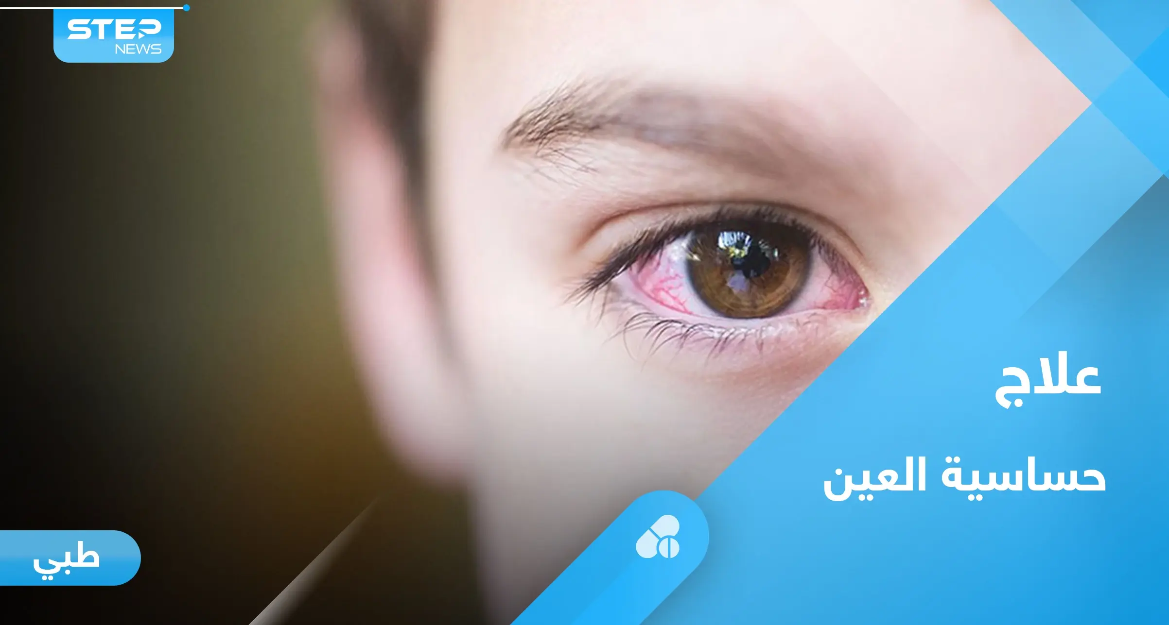 تعرف على علاج حساسية العين عند الاطفال بطرق مختلفة: علاج حساسية العين