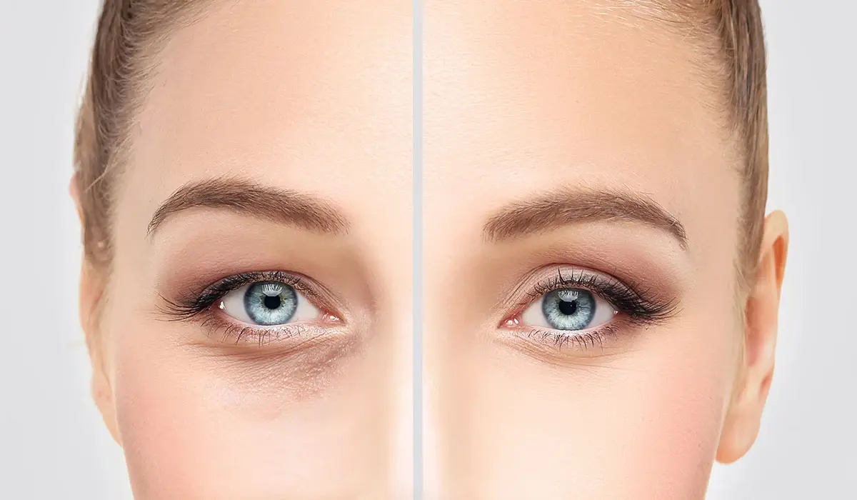 عمليات تجميل العيون .. أنواعها تكلفتها ومخاطرها: تجميل ومكياج