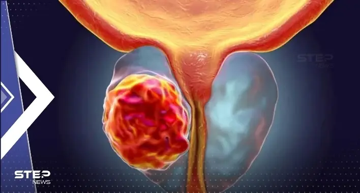 باحثون يكشفون لأوّل مرّة عن إنزيم يمكن استهدافه لقتل سرطان البروستات: سرطان الثدي