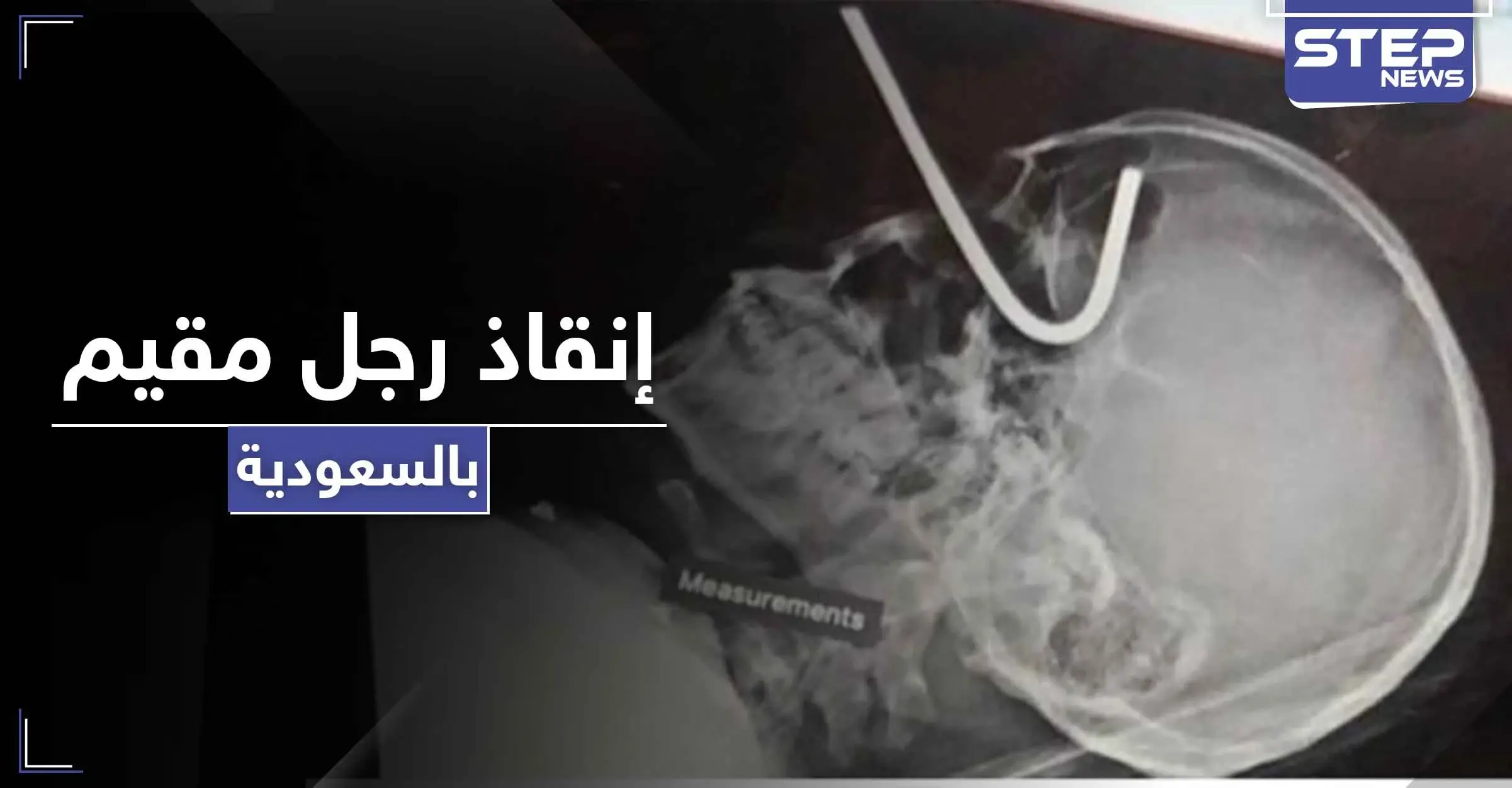 بالصور|| إنقاذ رجل مقيم بالسعودية دخل سيخ تعليق الأضحية بعينه إلى جمجمته: عمل جراحي