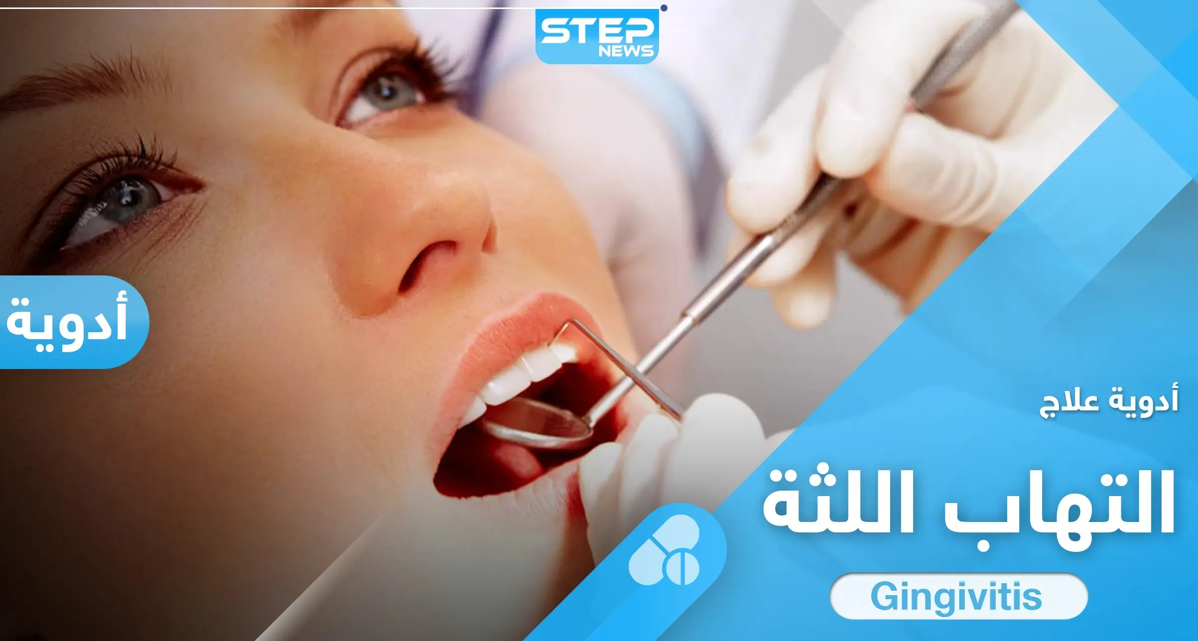 5 من افضل ادوية علاج التهاب اللثة المتعارف عليها إليك بها: التهاب اللثة دواء