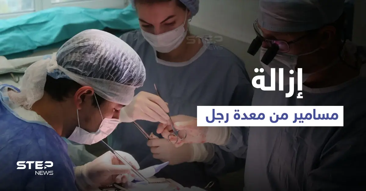 عملية جراحية معقدة لرجل ابتلع المسامير والبراغي لشهر كامل والسبب الكحول (صورة): مسامير