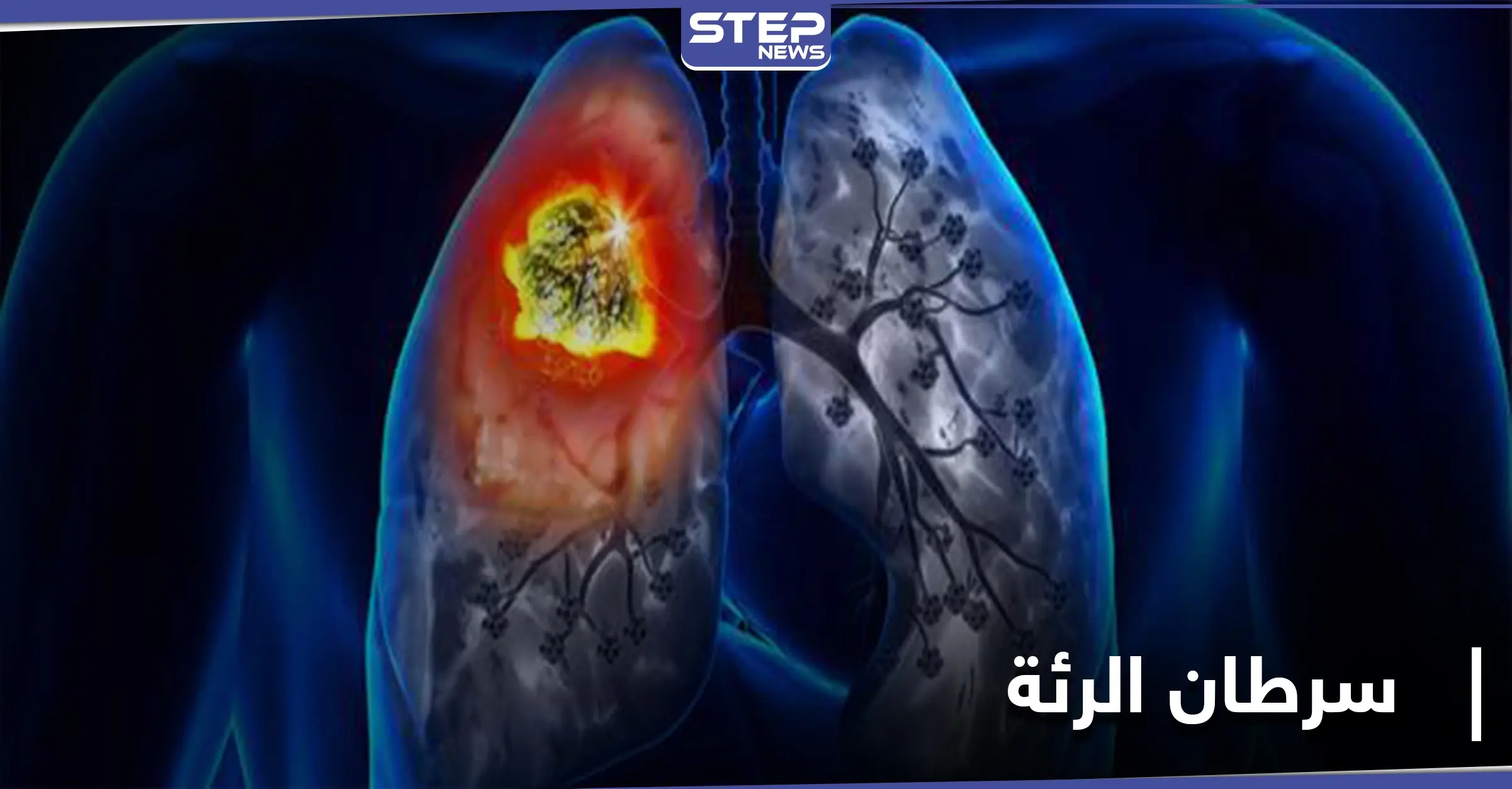 أورام غير متوقعة قد تكون دليلًا على الإصابة بـ سرطان الرئة: ضيق التنفس