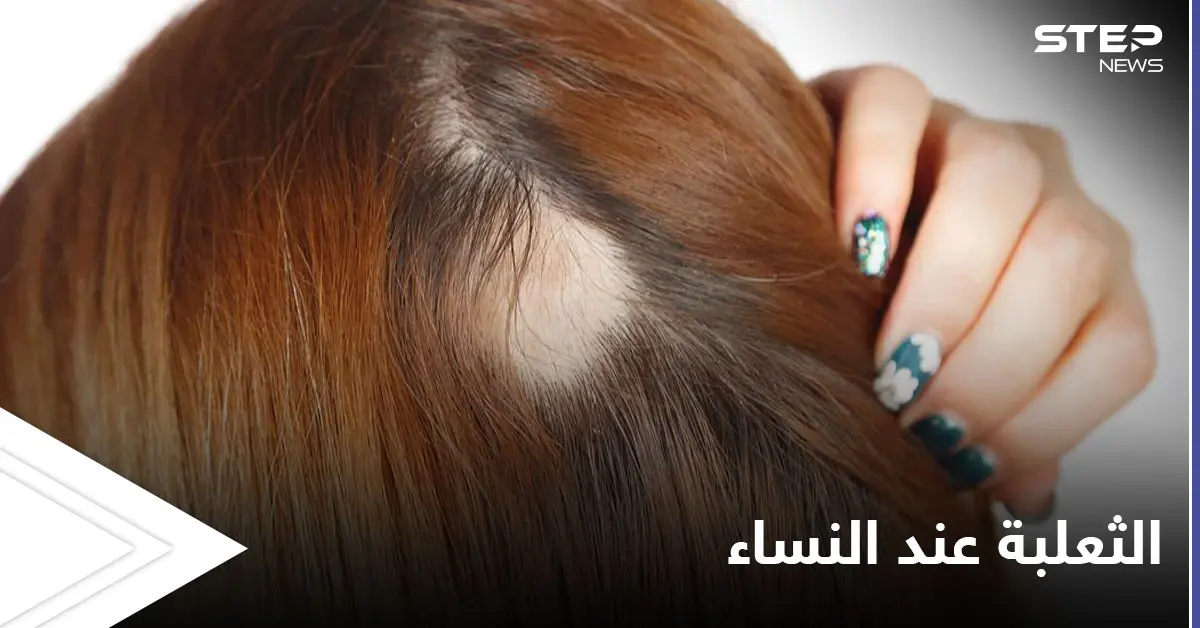 الثعلبة عند النساء.. تعرف على الأسباب وطرق العلاج: تساقط الشعر