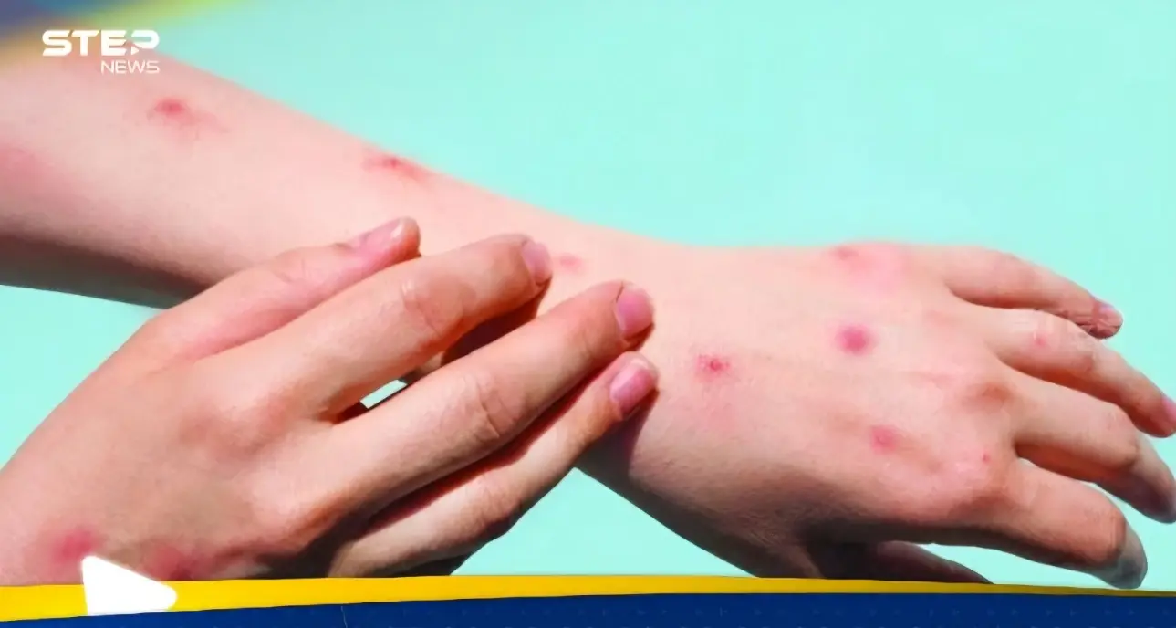 الصحة العالمية ترفع حالة الطوارئ بشأن جدري القرود: الصحة العالمية