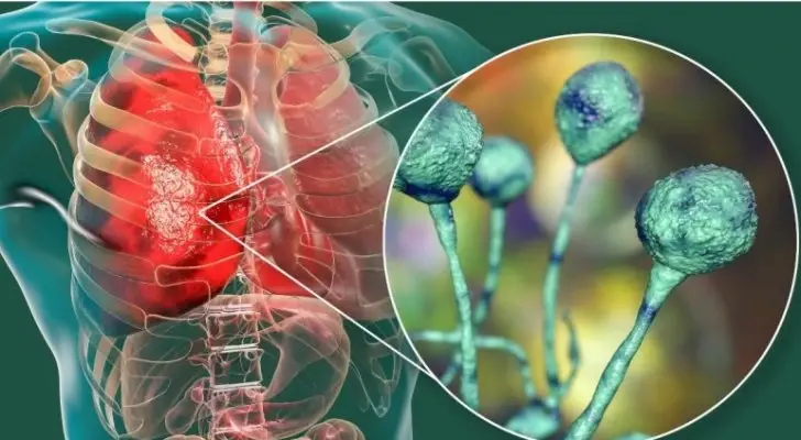 منظمة الصحة العالمية تكشف لـ"ستيب" الوضع الوبائي في المنطقة العربية وخطر "الفطر الأسود" ونجاعة اللقاحات: الفطر الأسود