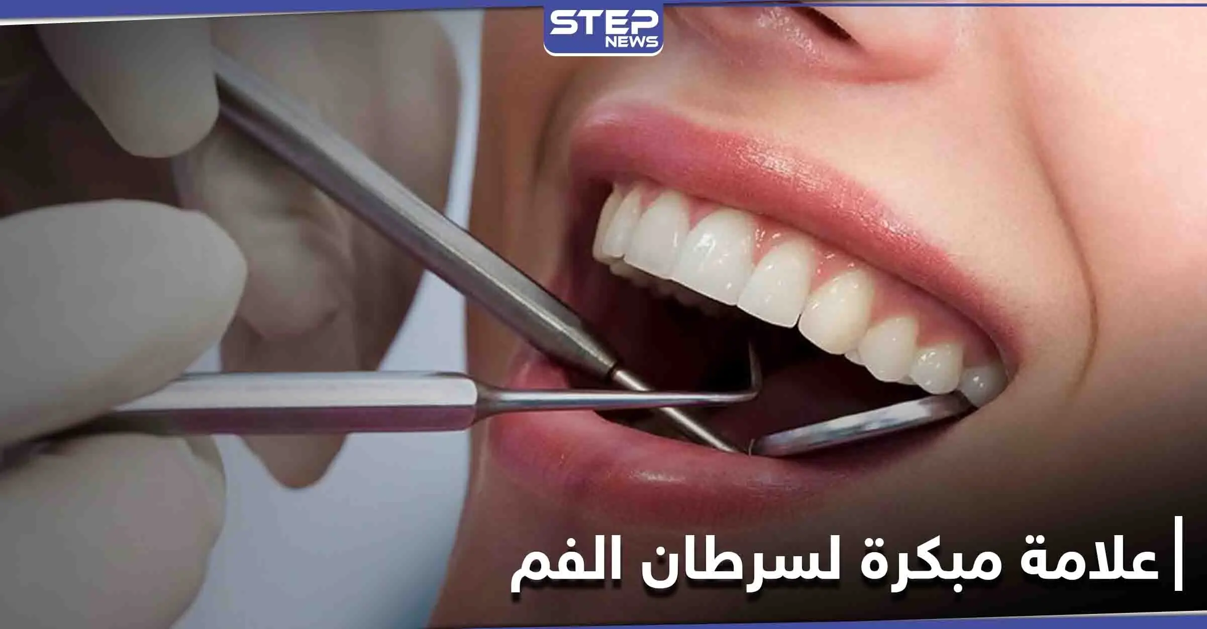 علامة بسيطة على الشفاه غير مبررة قد تكون دليل على الإصابة في سرطان الفم: السرطان