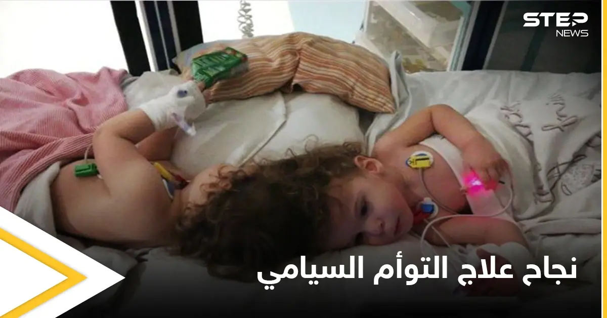 في حالة طبية نادرة.. نجاح علاج التوأم السيامي التركي وقدرتهما على المشي ومصادر تكشف التفاصيل: التوأم السيامي