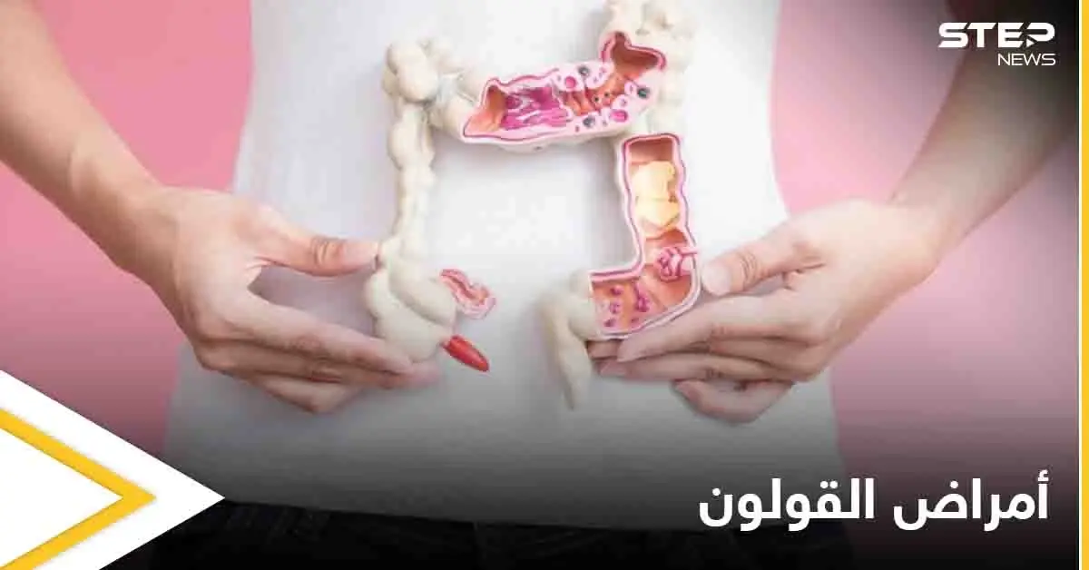 3 أمراض تصيب القولون تعرف على أعراضها وكيفية التفريق بينها: سرطان القولون