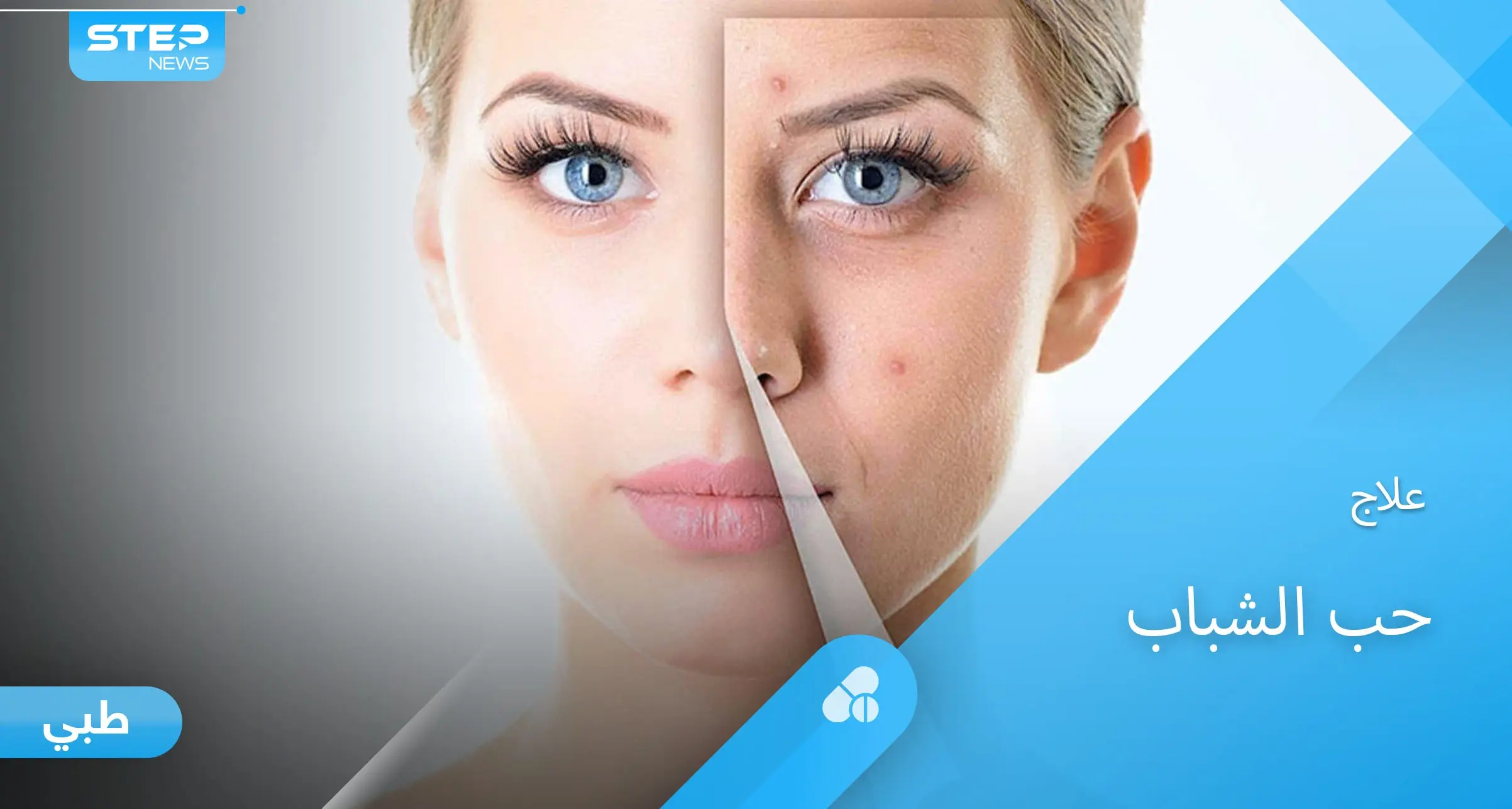 أسباب ظهور حب الشباب وطرق العلاج الفعالة إليك أهم المعلومات: علاج حب الشباب