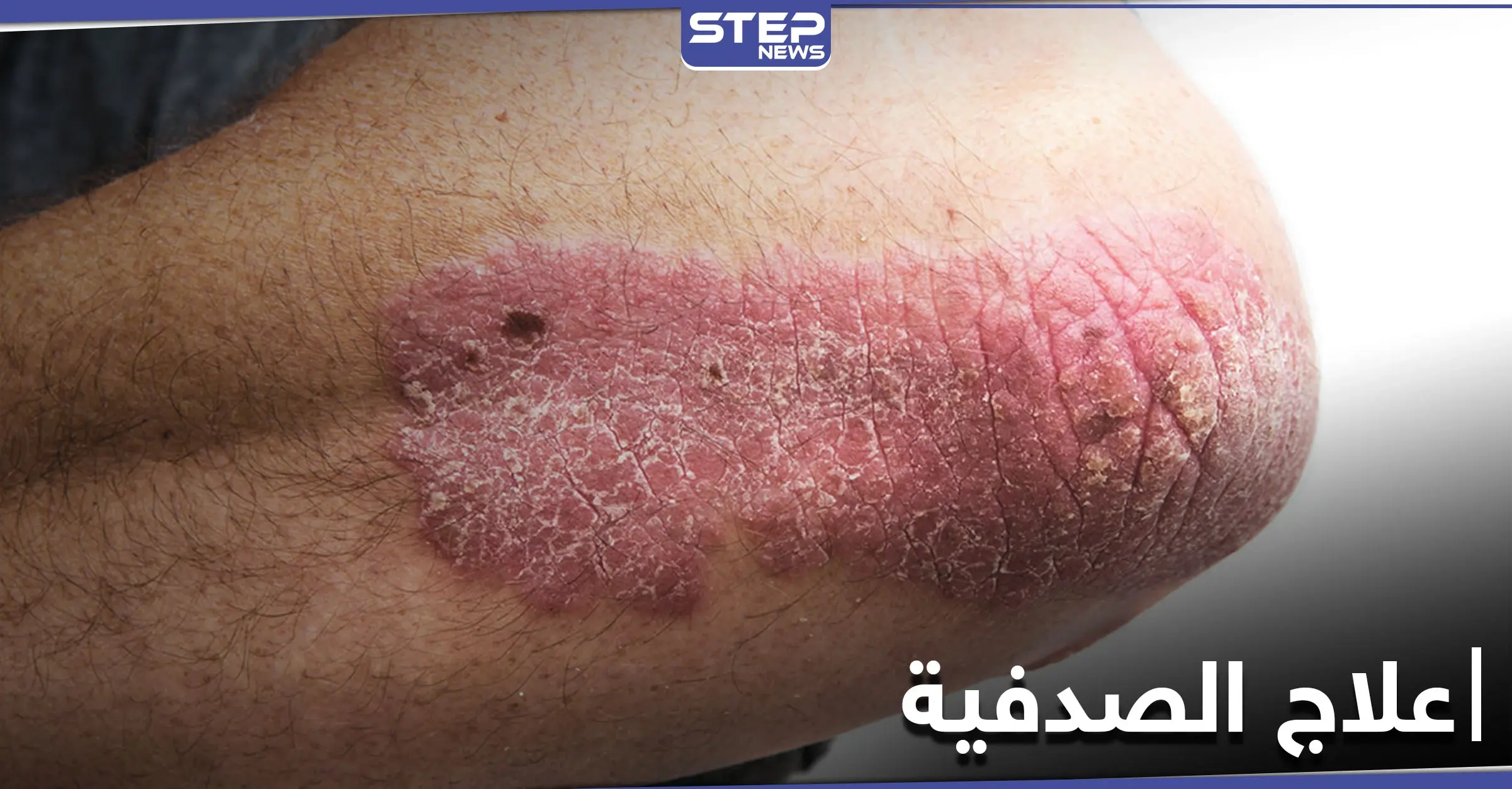 أثر النظام الغذائي على علاج الصدفية.. أنواعها وطرق الوقاية منها: الصدفية