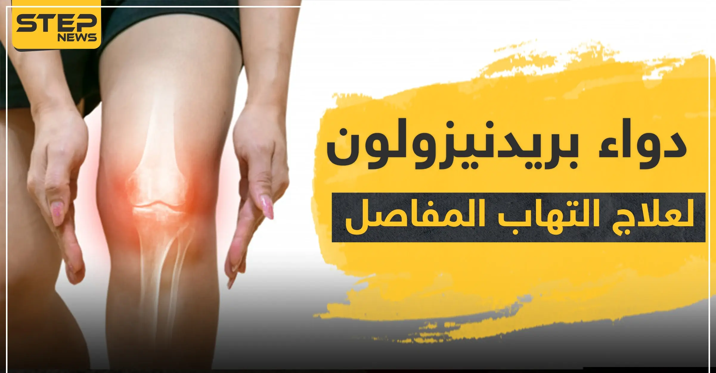 دواء prednisolone بريدنيزولون لعلاج التهاب المفاصل: التهاب المفاصل