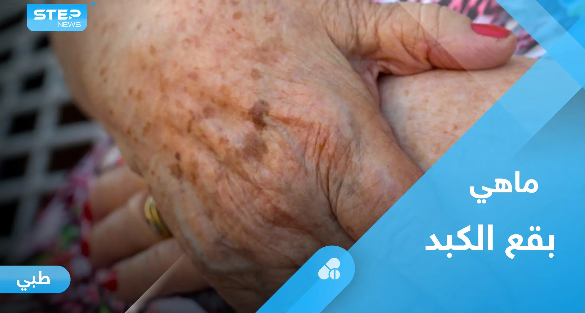 بقع الكبد.. ما هي ومتى تستدعي القلق: -