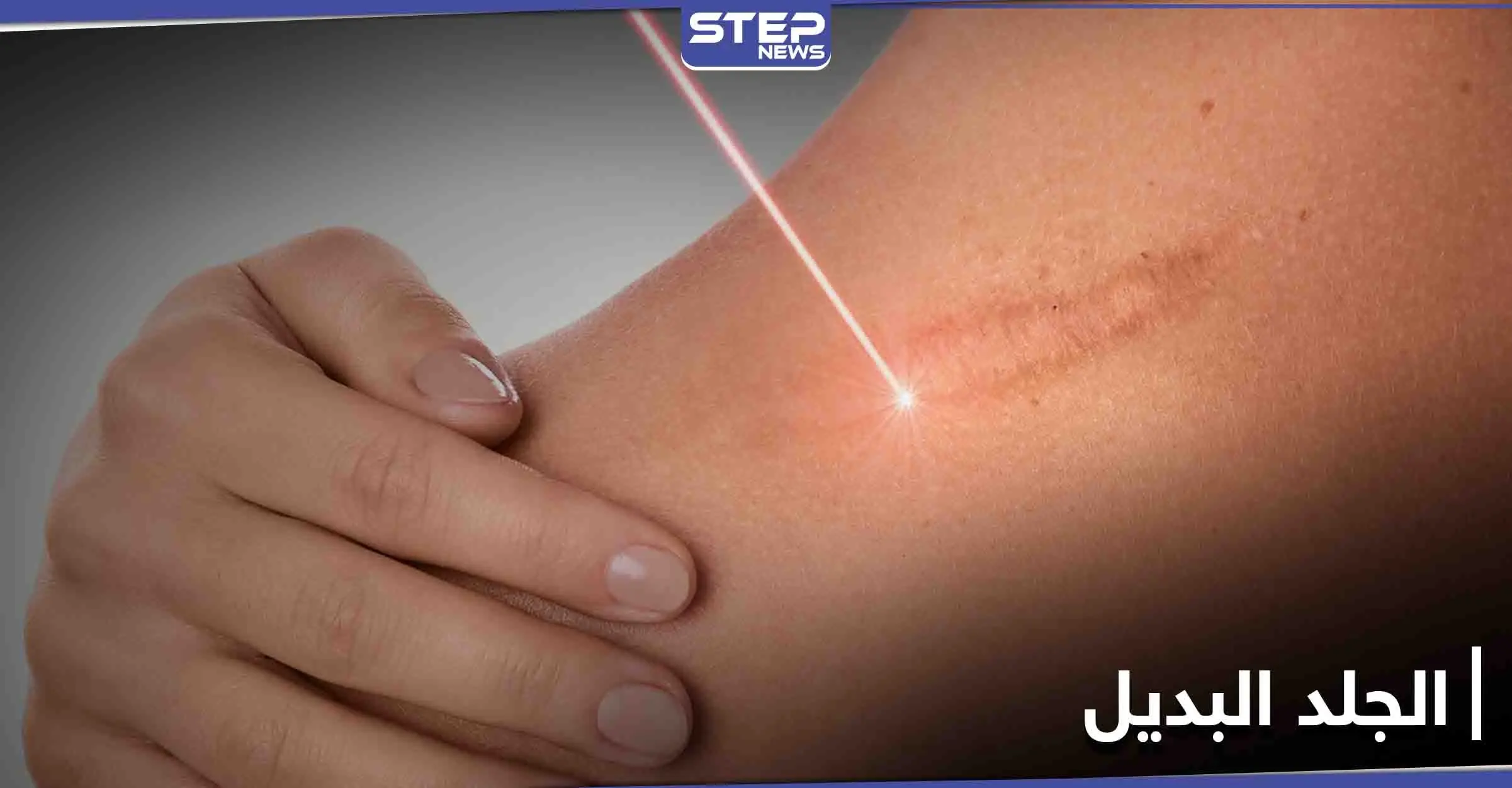 مسدس طبي.. اختراق يولد جلداً بديلاً ويغطي الحروق: مسدس طبي