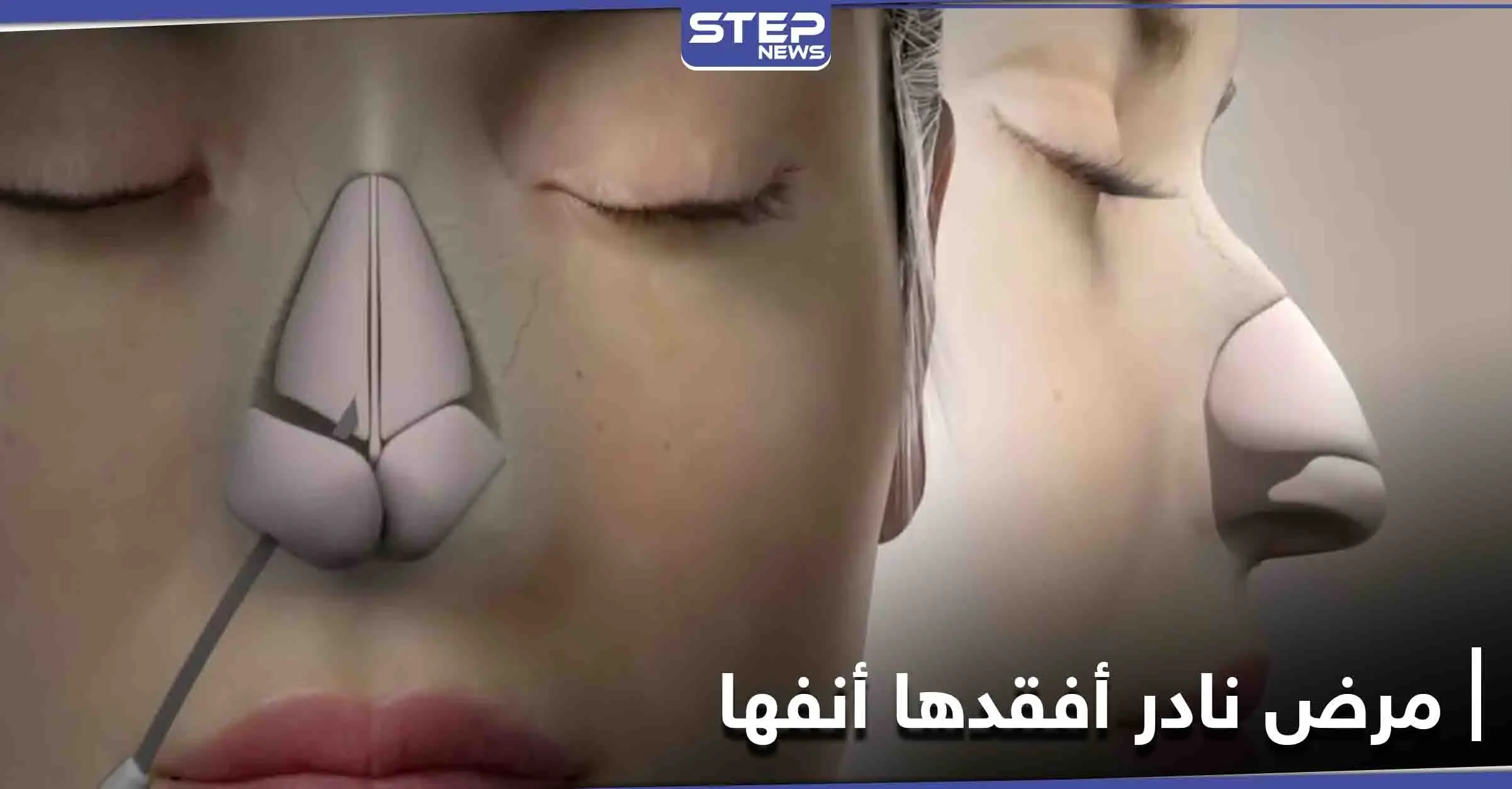 مرض نادر أصابها فأصبحت بلا أنف والأطباء يكشفون الأعضاء المعرضة لهذا التلف: تجميل