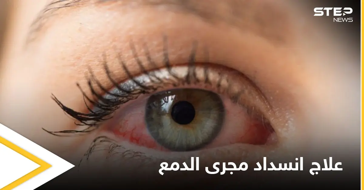 علاج انسداد مجرى الدمع لدى البالغين وأهم المعلومات عنه: قطرات العين