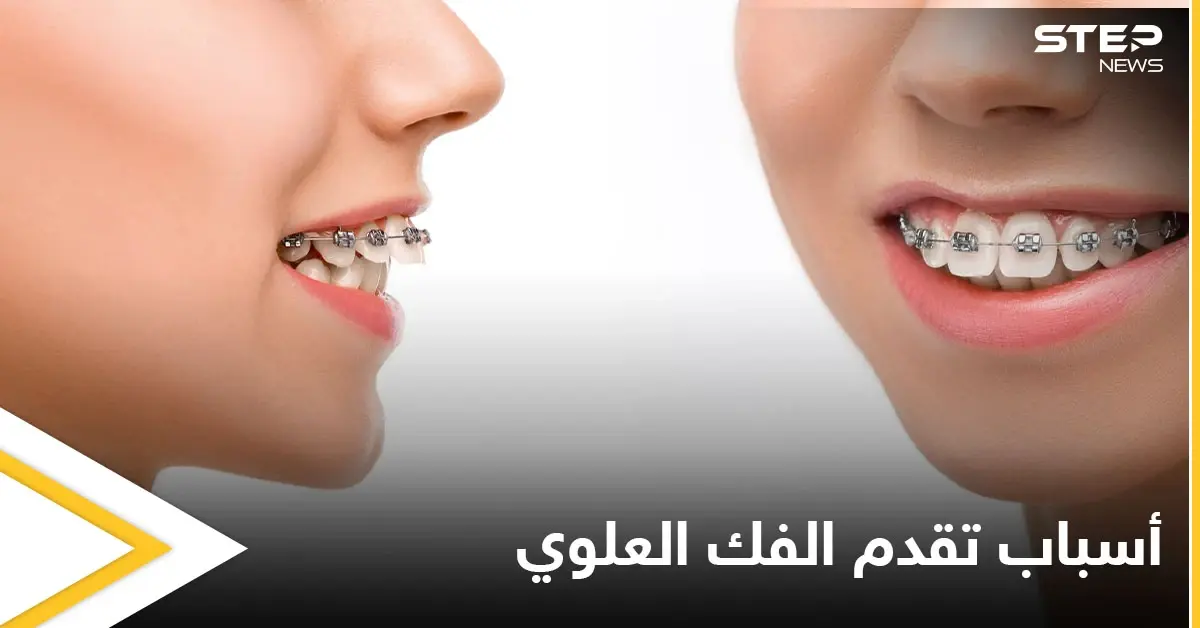 هل هي الوراثة.. الكشف عن أسباب تقدم الفك العلوي وأعراضه وطرق العلاج: الهرمونات