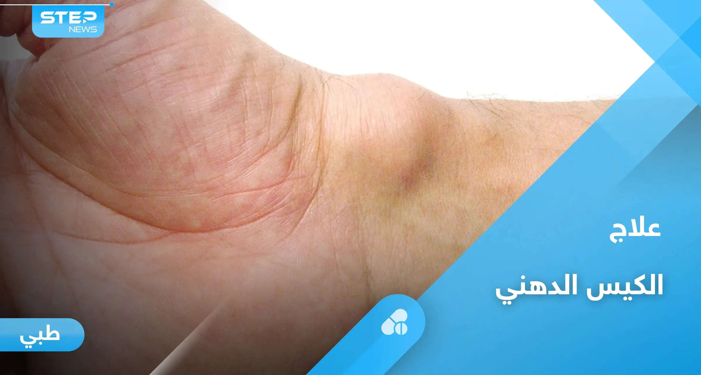 الكيس الدهني.. هل هو خطير وأبرز أعراضه وعلاجه إليك أهم المعلومات: السرطان
